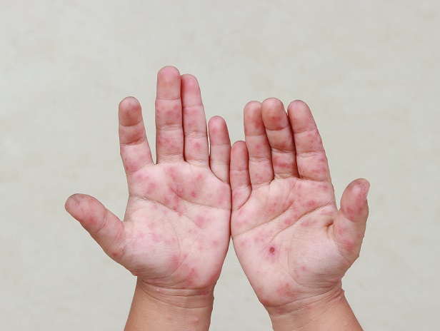 如何處理腸病毒引起的水泡？需要擦藥嗎？